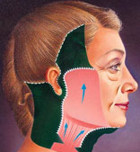 facelift_2