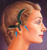 facelift_3
